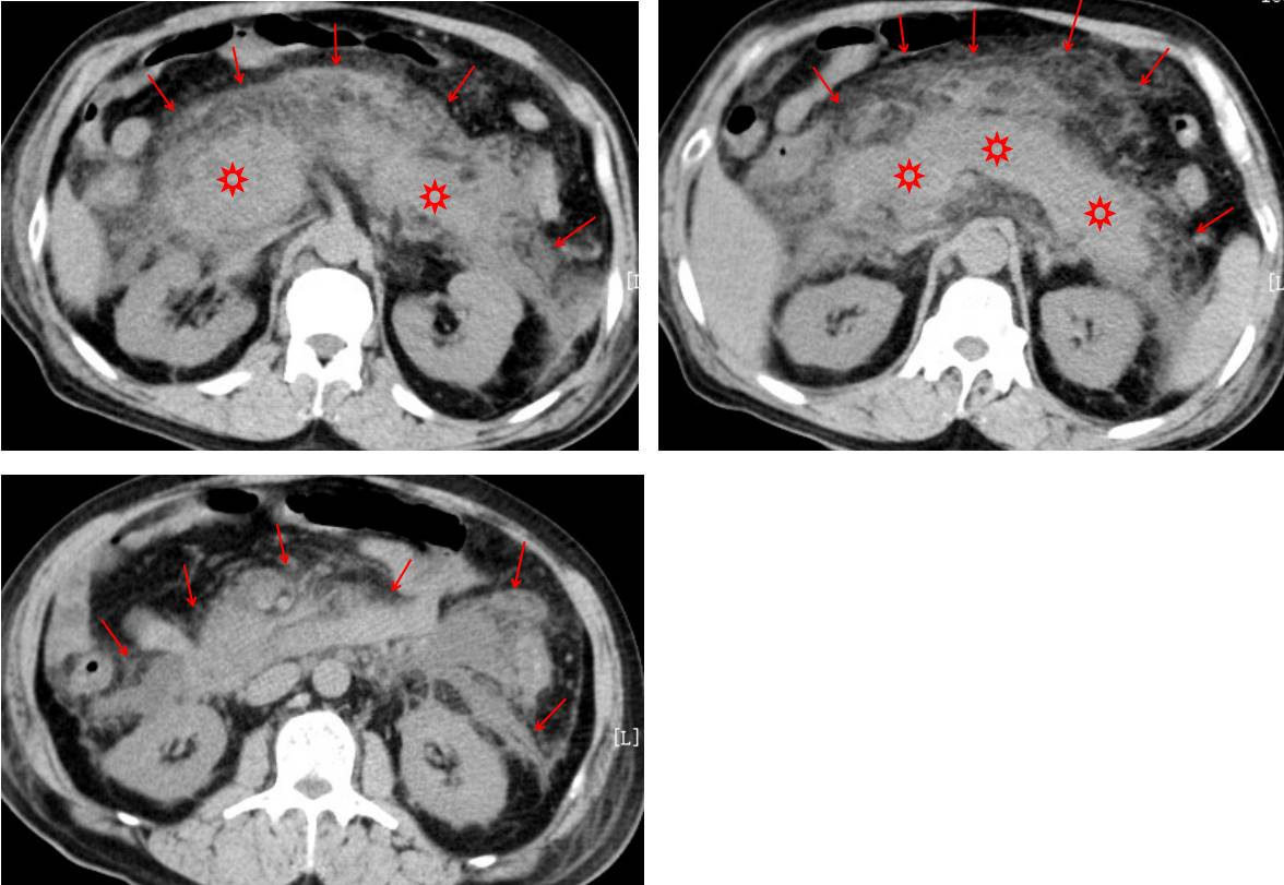 ct平扫示胰腺肿胀并周围广泛渗出