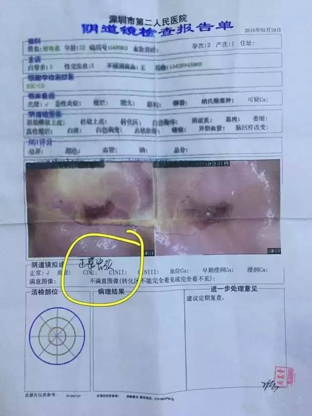 【案例分享】她患了宫颈癌四处求医,因为相信完美,最后完美也没有让她