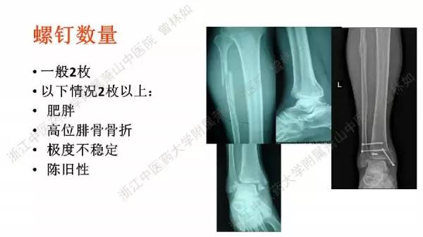 踝骨折合并下胫腓联合损伤的治疗