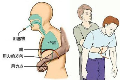 海姆立克急救法(适用:成人)