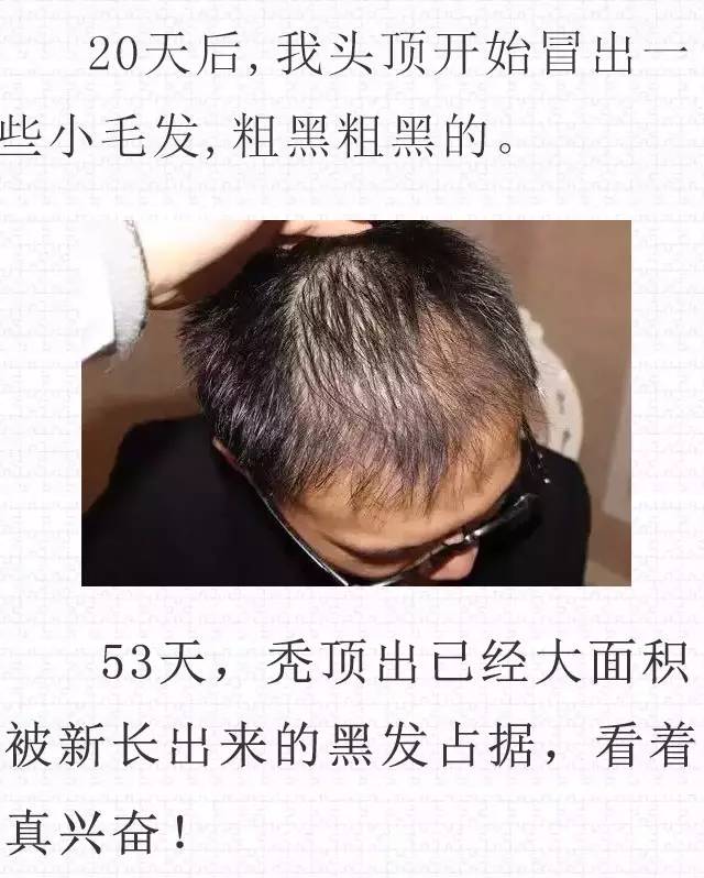 脱发白发秃头的生发秘方大公开,男人女人都受用!马上删除了.