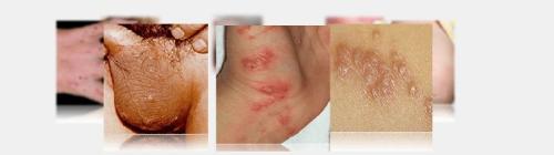 疥疮疥螨常寄生于皮肤较薄而柔软的部位