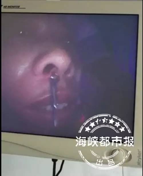 男子鼻腔内"养"了只吸血蚂蟥,和洗脸有关!