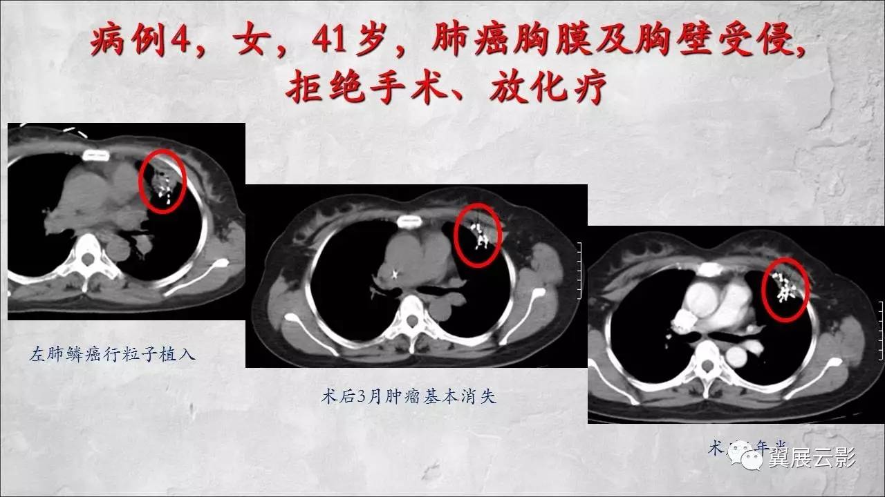 【课后精彩发布】ct引导下肺癌的介入治疗