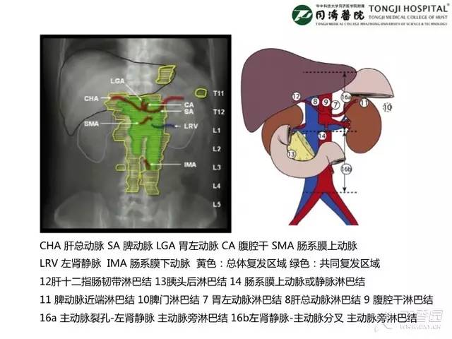 为了让大家看清上腹部淋巴结转移是什么样子滴,文末附赠几张已经在