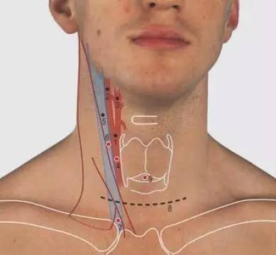 颈外动脉,4.颈总动脉入路点,5.颈内静脉,6.