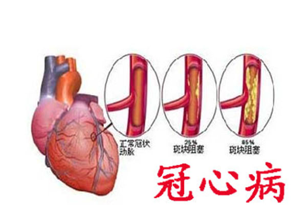 冠状动脉狭窄怎么办