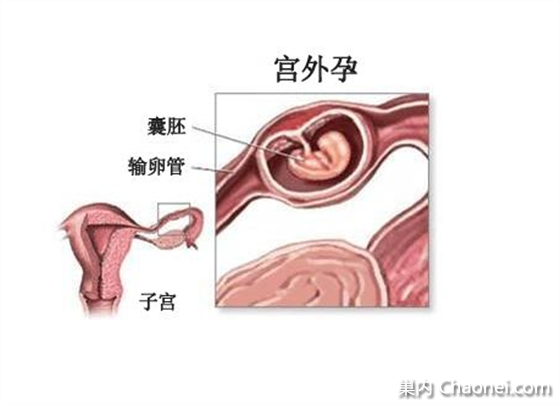 因为宫外孕切除了一根输卵管,还能怀孕吗?