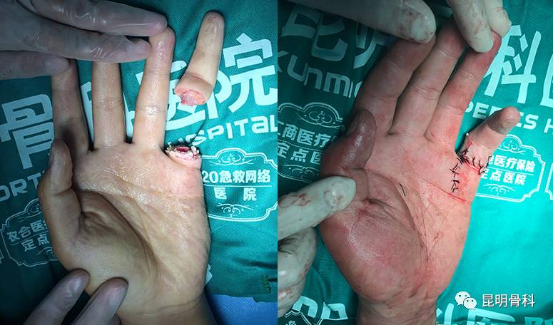 18岁小伙剁排骨斩断指头,3小时后手指在昆明骨科医院