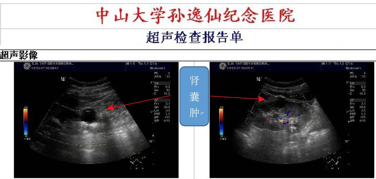 肾积水肾积水本身不是疾病,而是各种疾病的表现形式,如肾结石,肿瘤,输