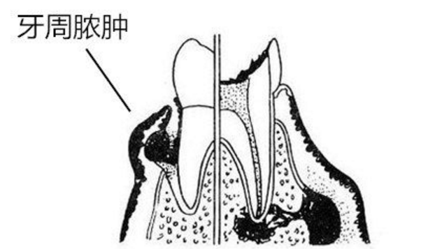 牙周脓肿问题简介