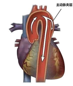 动脉夹层术后长寿命 心脏主动脉夹层手术后危险期