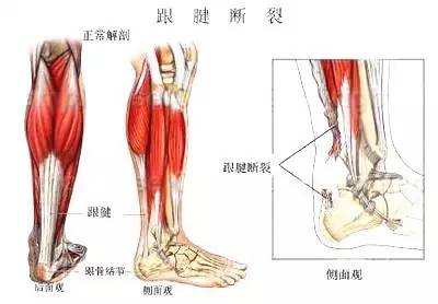 跟腱炎一般指跟腱急慢性劳损后形成的无菌性炎症,但严重的会引发跟腱