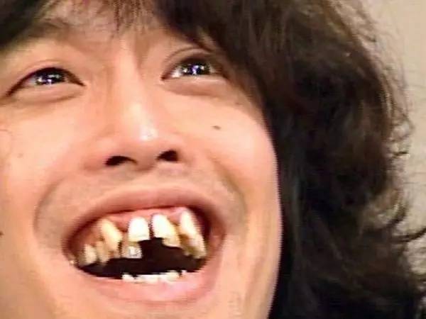 日本还专门有个词叫"八重齿",即虎牙外露突出,和其他牙齿挤在一起,从
