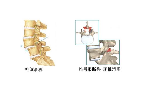 腰椎滑脱手术可以报销吗 腰椎滑脱保险报销吗