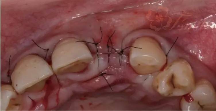 种植修复前牙单颗牙缺失的骨增量方式和植入时机|wdf疑难病例圆桌会