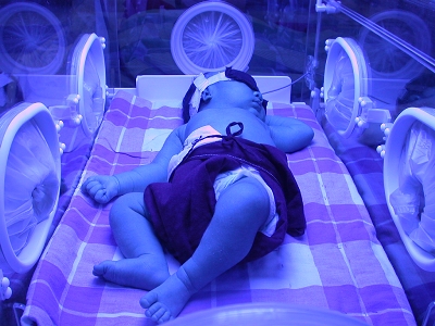 如果是病理性的,就需要在医生的指教下住院照蓝光,就是让新生儿在保温