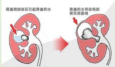 揭秘泌尿结石9大误区,你是不是也是这么想的?