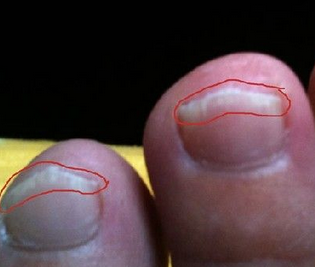 或指甲下面慢慢蔓延,从而形成甲下脓肿,在指甲下面可看到黄白色脓液