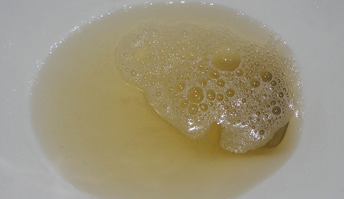 小便时,尿液里面有泡沫一定是肾功能受损吗?_