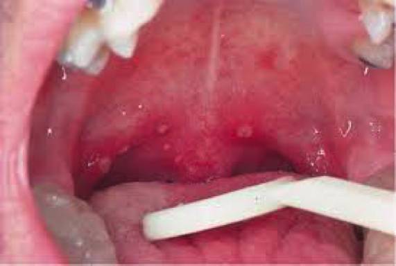 小儿疱疹性咽峡炎（口腔炎）与手足口病的区别及小儿推拿穴位选择-图片1