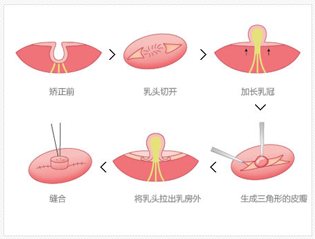 乳头凹陷需要做手术吗