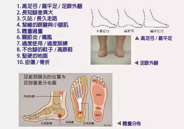 另外从结构上有导致足底筋膜不正常拉力之因素,例如扁平足,高弓足