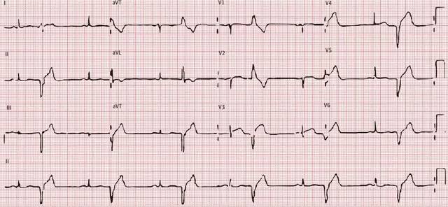 心电图挑战容易误诊的应激性心肌病
