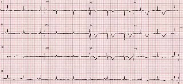 心电图挑战容易误诊的应激性心肌病