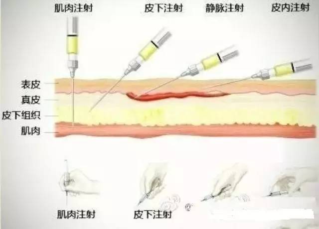 静脉注射(iv)及输液法,就是所谓的输液打吊针.