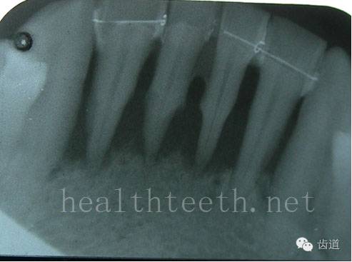 外院做的牙周固定,牙片显示牙槽骨的水平吸收