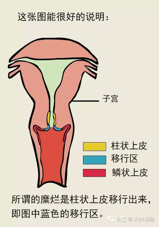 【宫颈柱状上皮移位】k掉了【宫颈糜烂】 早在2008年,就取消了"宫颈