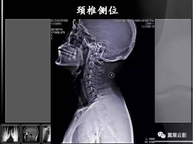 观察有无寰枢关节脱臼,齿状突骨折或缺失(张口位片);第七颈椎横突有