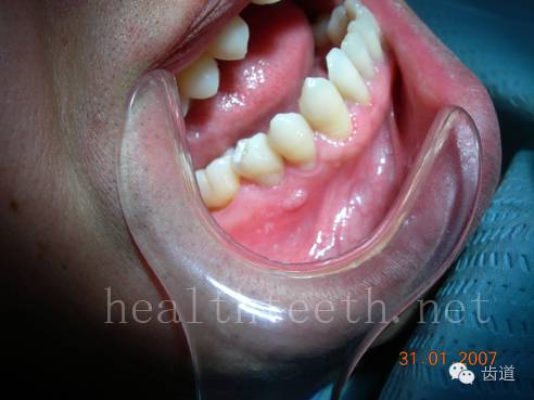 简单明了,通过图片让你的患者了解口腔常见疾病(下)