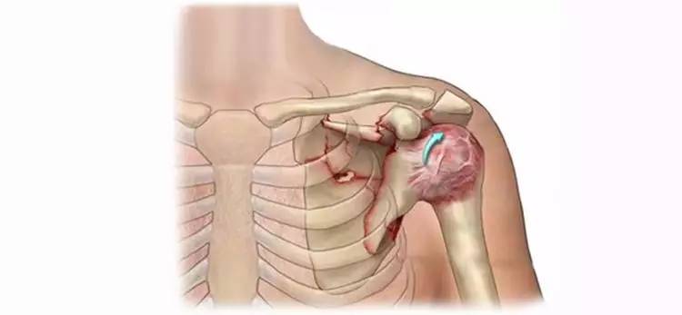 冻结肩/粘连性关节囊炎有自限性的特点,未经治疗者整个病程为12～42个
