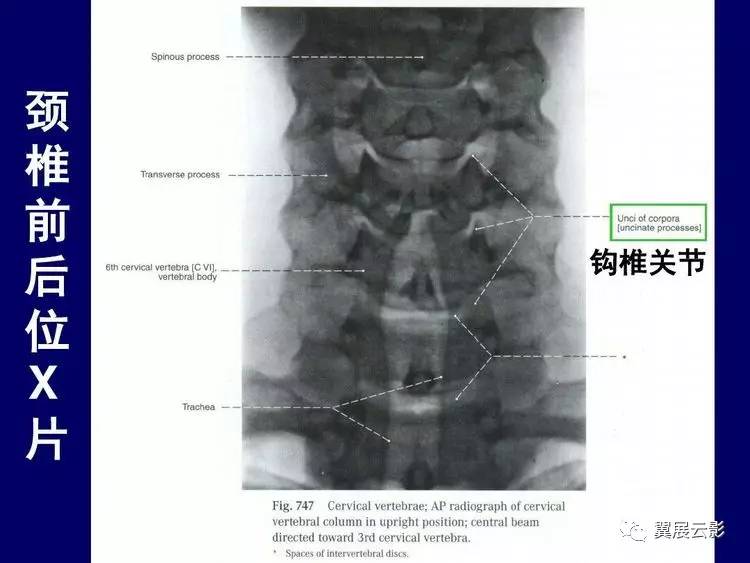 钩椎关节及椎间隙有无增宽和狭窄.