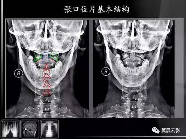 观察有无寰枢关节脱臼,齿状突骨折或缺失(张口位片);第七颈椎横突有