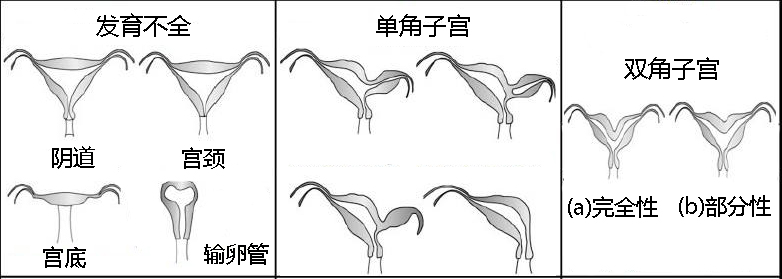 副中肾管衍化物融合障碍所致异常:双子宫,双角子宫,鞍状子宫和纵膈