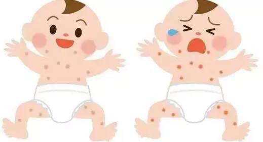 宝宝脂性湿疹怎么办