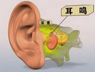 听说耳聋也有分级是真的吗?