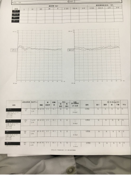 226hz右耳a型曲线,左耳as型曲线 听性脑干反应检查