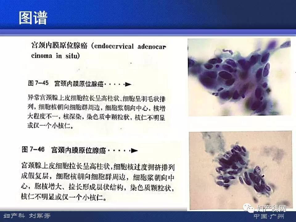 让你快速掌握宫颈液基细胞学意义及准确解读