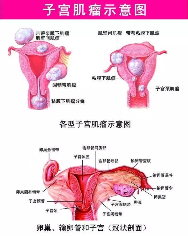 5个月嫂中就有1个有子宫肌瘤,如果出现这些恶性肿瘤症状可能要手术