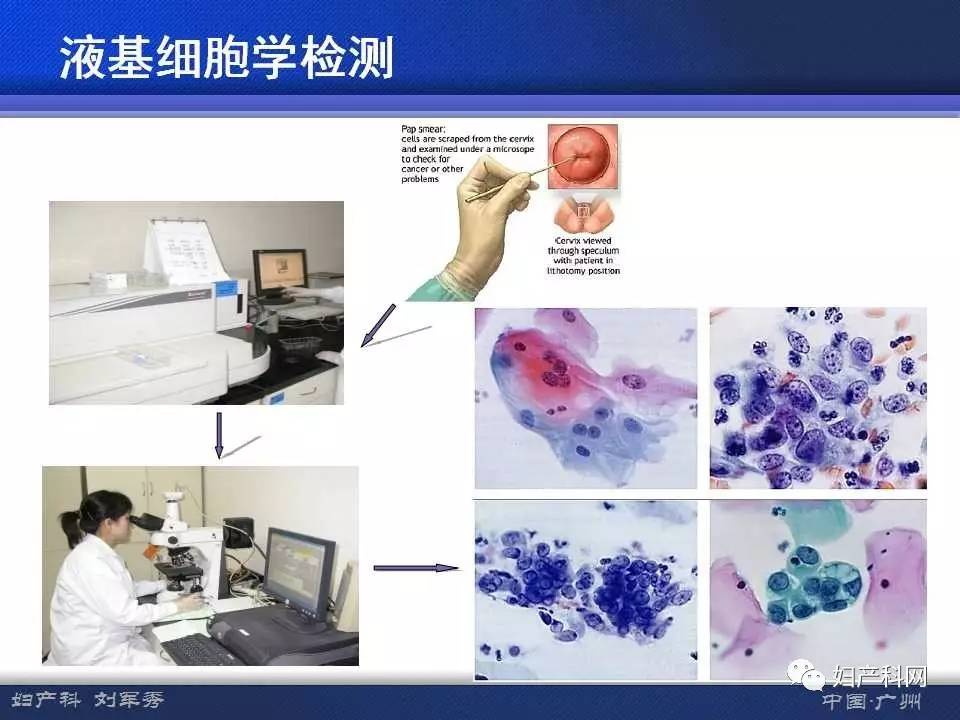 让你快速掌握宫颈液基细胞学意义及准确解读