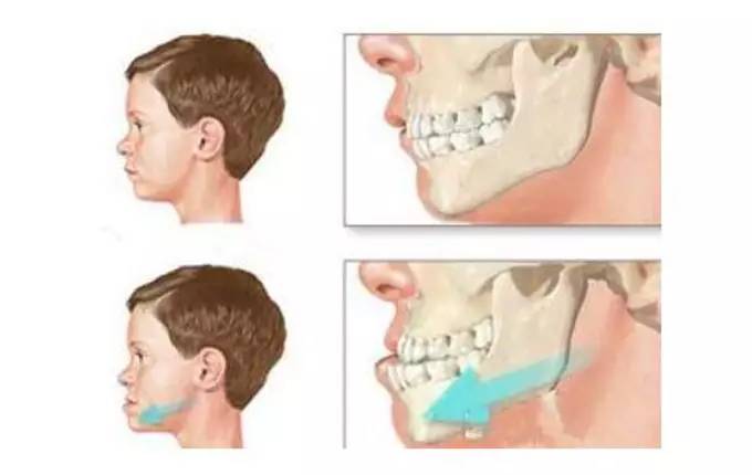 正常牙齿咬合时,上牙是在下牙的外面,如果下牙在外,就是"地包天"了