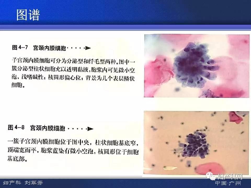 让你快速掌握宫颈液基细胞学意义及准确解读