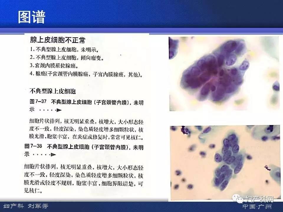 让你快速掌握宫颈液基细胞学意义及准确解读