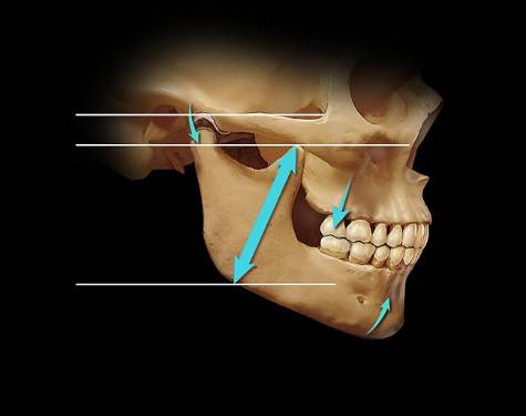 尖交错位时颌骨间的垂直位置关系,但髁突位置可以影响升颌肌群的长度