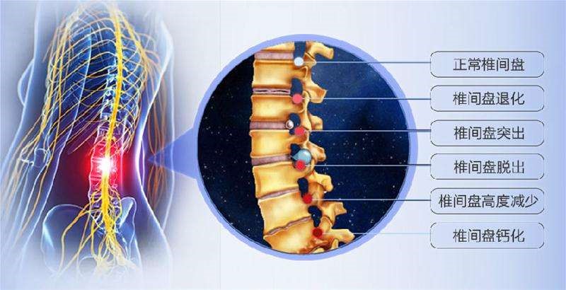 保卫"腰椎间盘"四种方法,简单易行