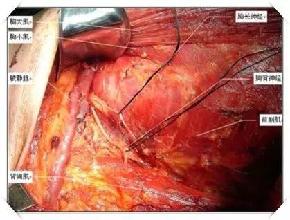 江涛:规范化淋巴结清扫是肿瘤外科根治手术的关键 含效果图